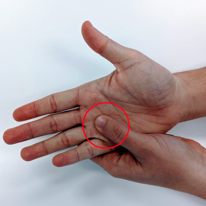 Springduim Hand & pols | Orthoclinic - Orthopedie Brugge