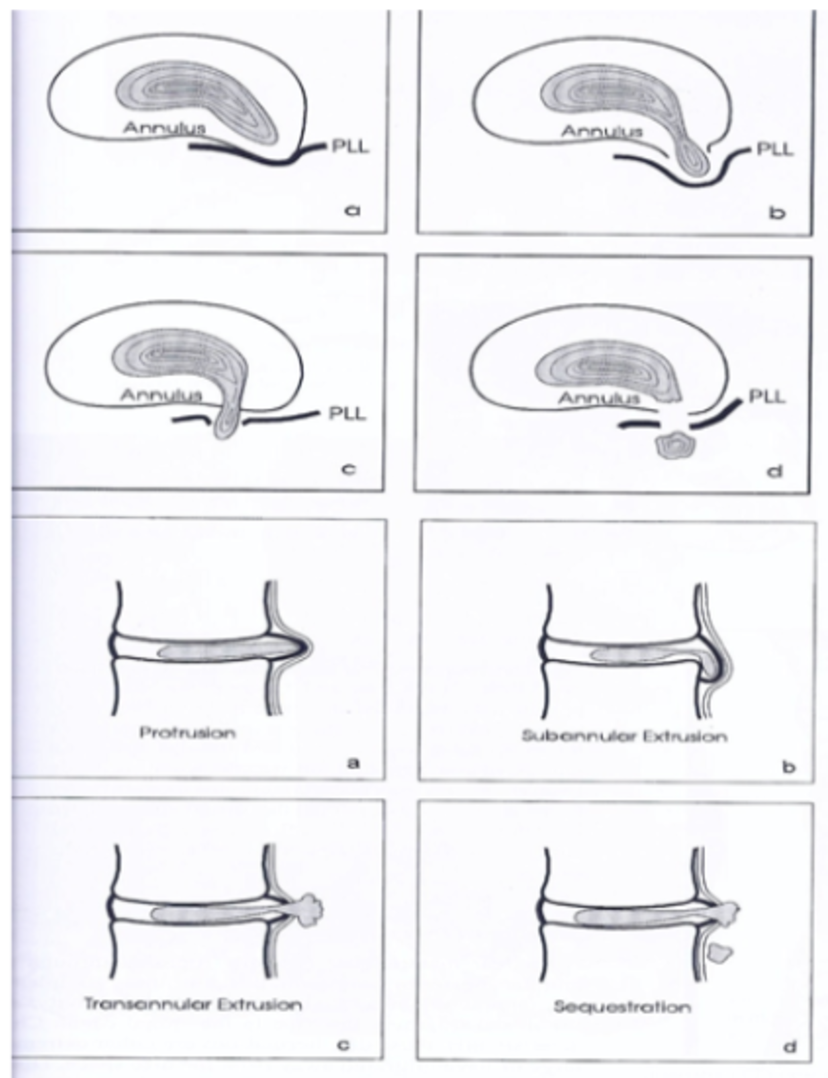 Discus hernia (lage rug) | Orthoclinic - Orthopedie Brugge