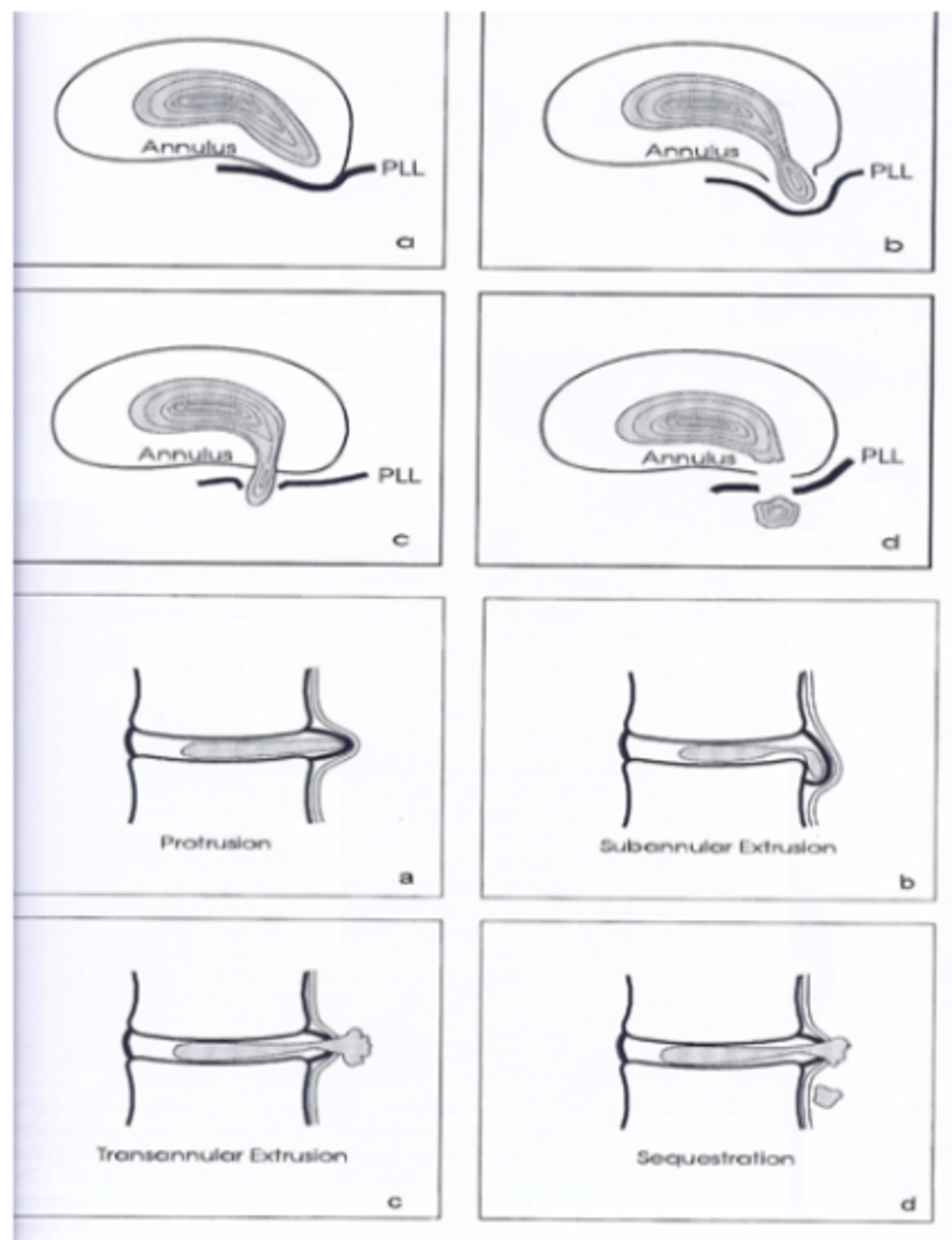 Discus hernia (lage rug) | Orthoclinic - Orthopedie Brugge