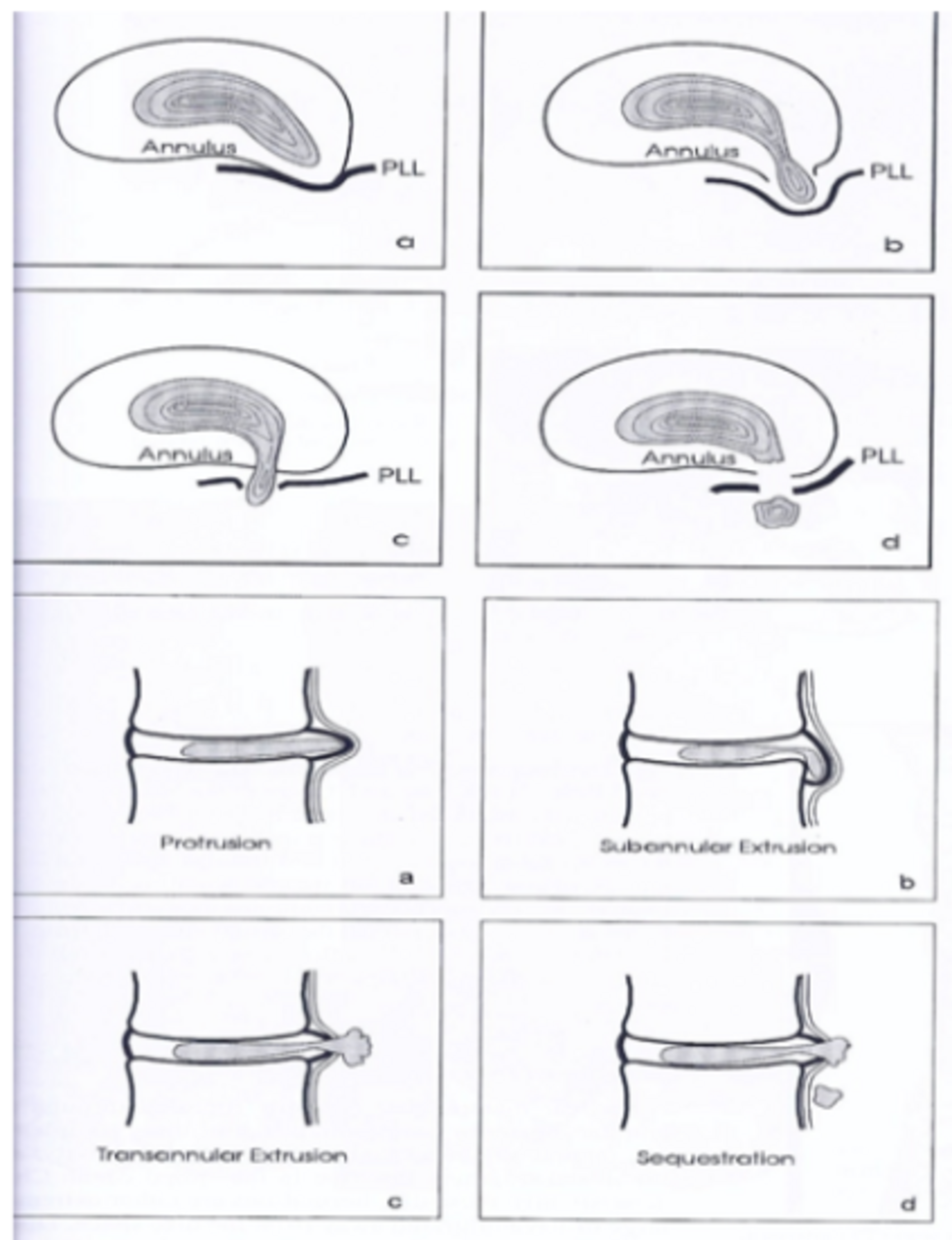 Discus hernia (lage rug) | Orthoclinic - Orthopedie Brugge