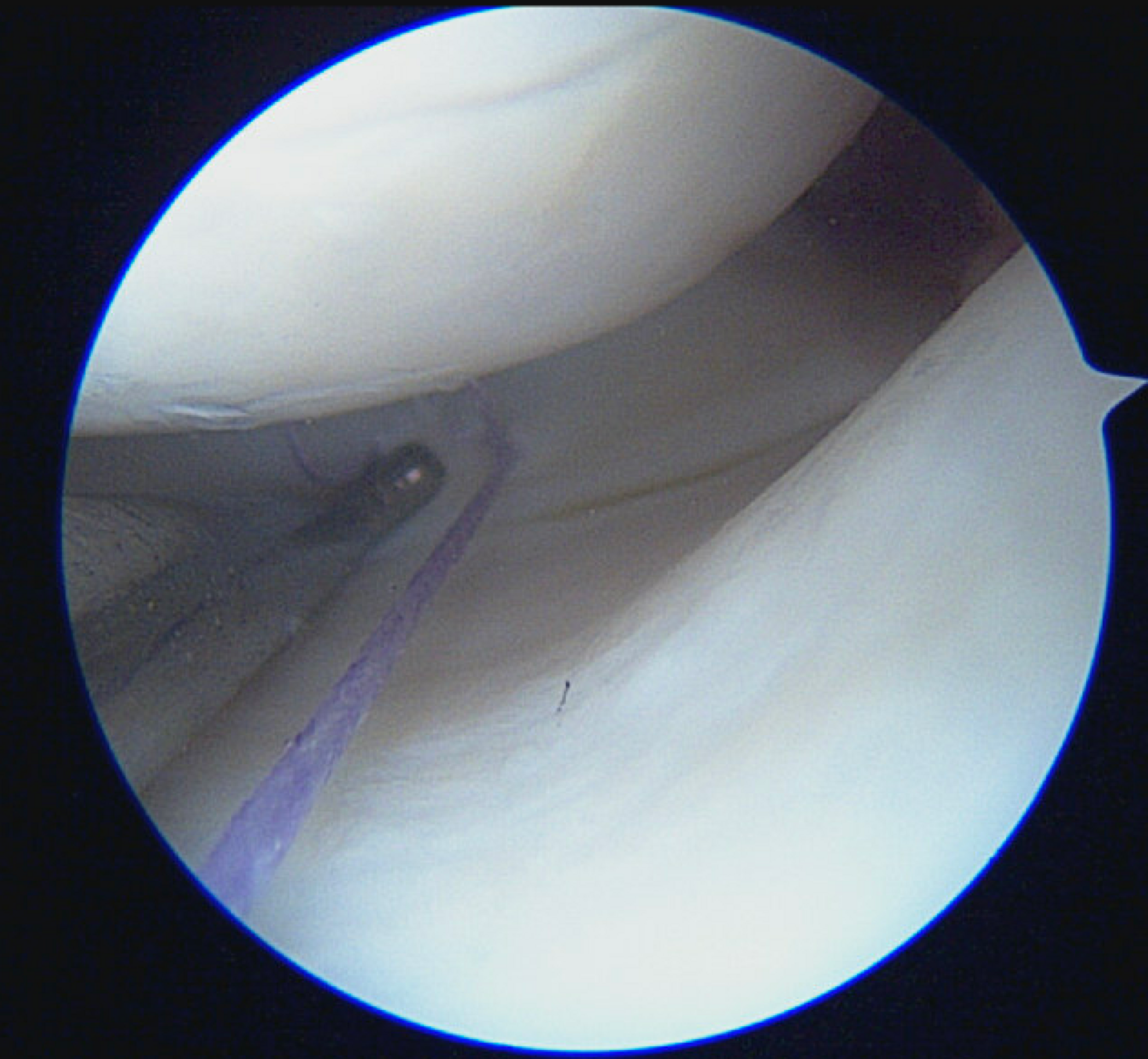 Meniscusscheur | Orthoclinic Brugge