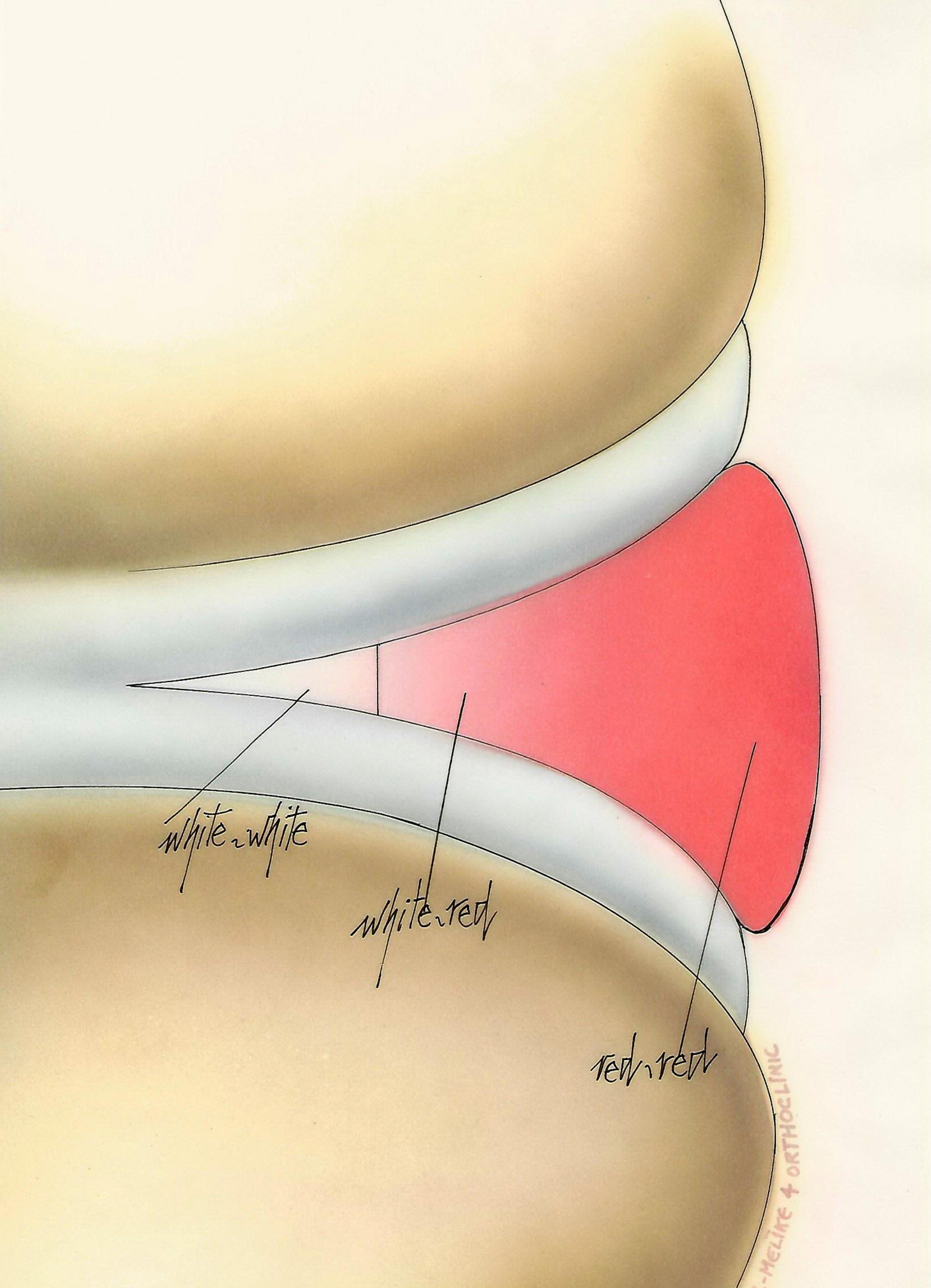 Meniscusscheur | Orthoclinic Brugge