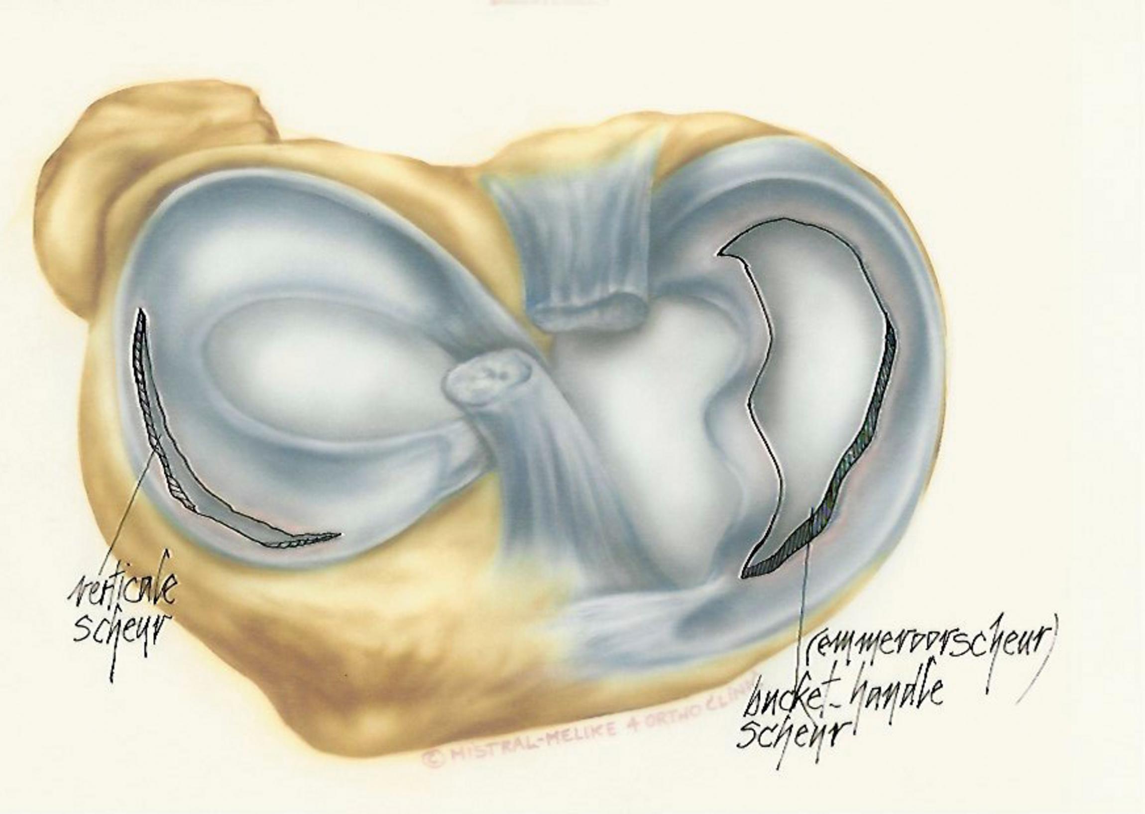 Meniscusscheur | Orthoclinic Brugge