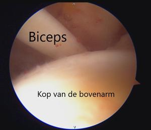 Verloop van de lange bicepspees in de schouder