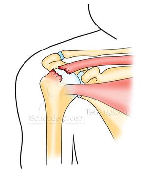 Scheur van de rotatorcuff