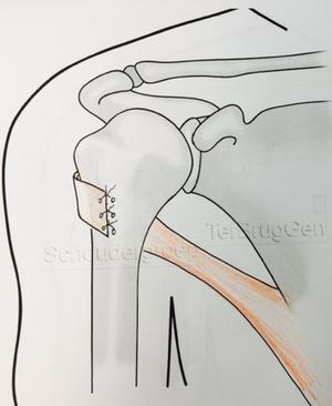 Latissimus dorsi transfer