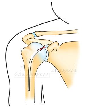 Scheur in de lange bicepspees