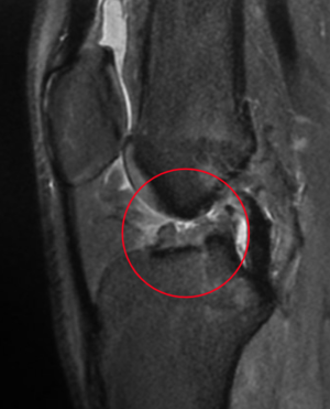 NMR: gescheurde voorste kruisband in de knie