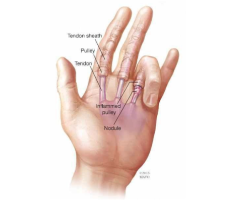 Springvinger Spalk Springvinger | Orthoclinic Brugge