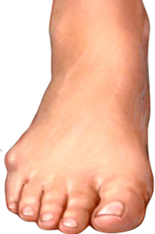 Wat is een bunion? - Veld Orthopedische Schoentechniek