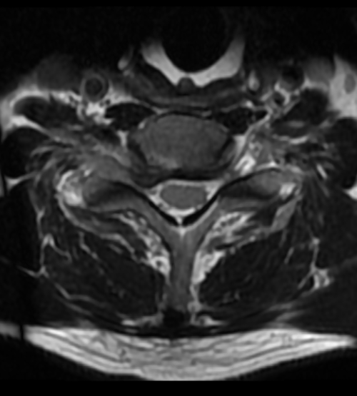 Discus hernia (nek) | Orthoclinic Brugge