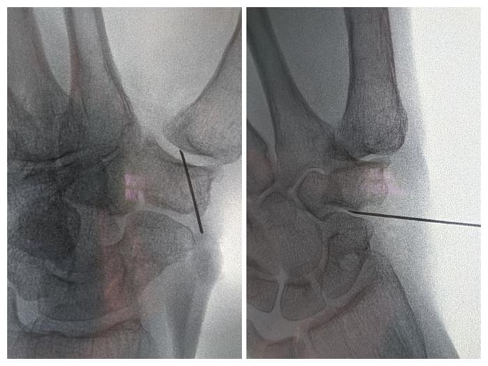 Infiltration Hand Example Infiltraties | Orthoclinic - Orthopedie Brugge
