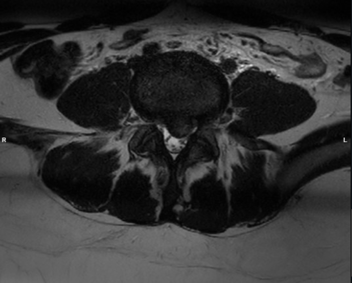 Discus hernia (lage rug) | Orthoclinic - Orthopedie Brugge
