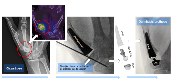 Duimbasisprothese | Orthoclinic - Orthopedie Brugge