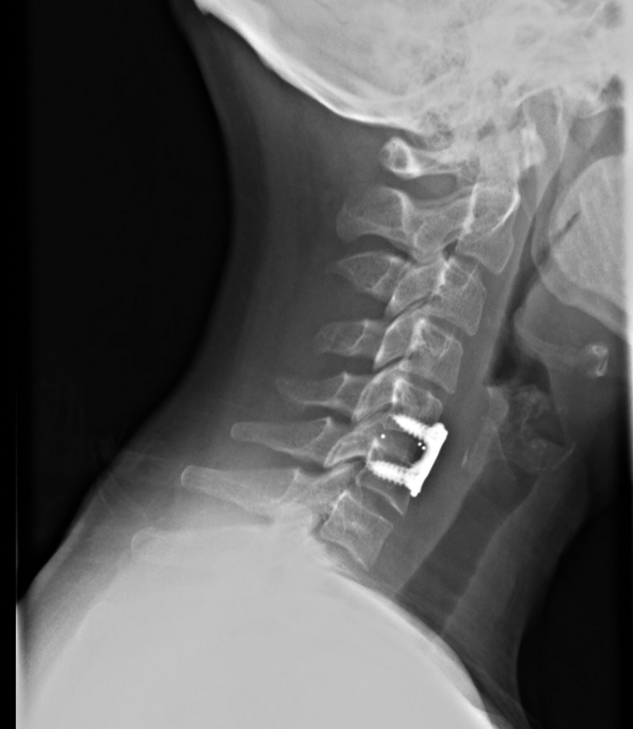 Discus hernia (nek) | Orthoclinic Brugge
