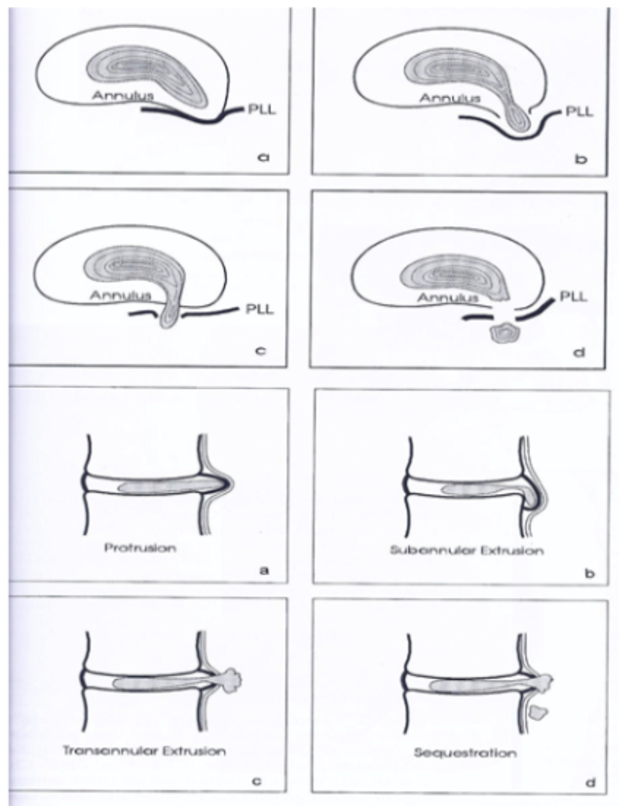Discus hernia (lage rug) | Orthoclinic - Orthopedie Brugge