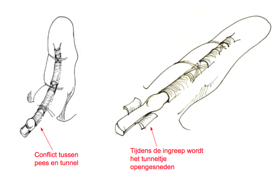 Springvinger Spalk Springvinger | Orthoclinic Brugge