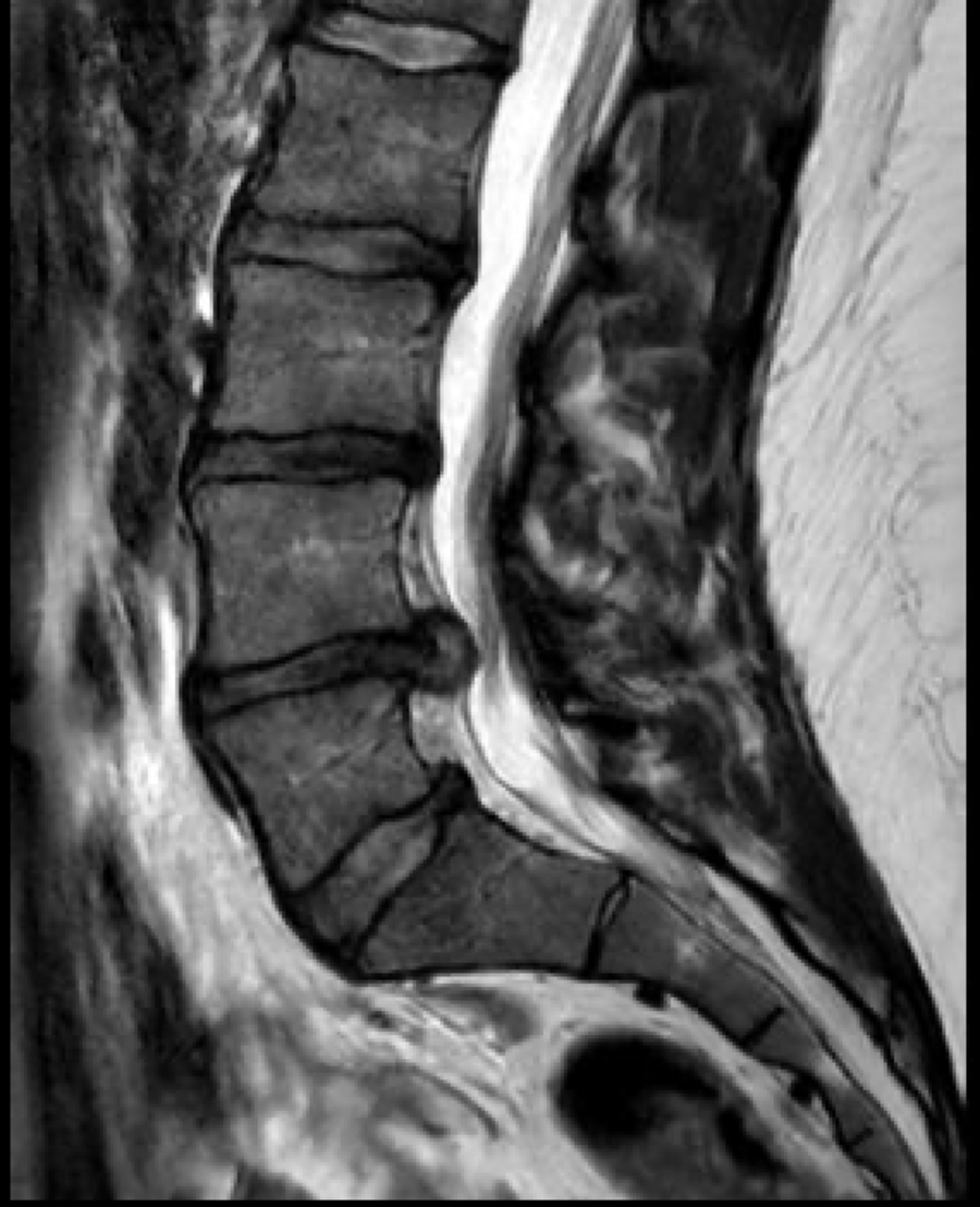 Discus hernia (lage rug) | Orthoclinic - Orthopedie Brugge