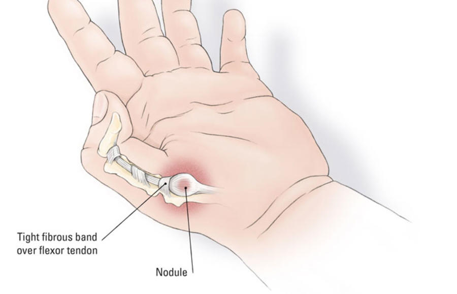 Congenitale springduim | Orthoclinic - Orthopedie Brugge